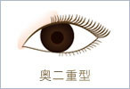 奥二重型