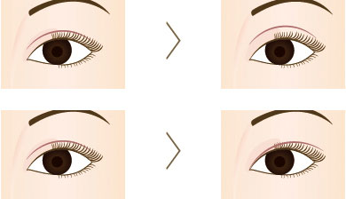 二重の幅や形を変更する